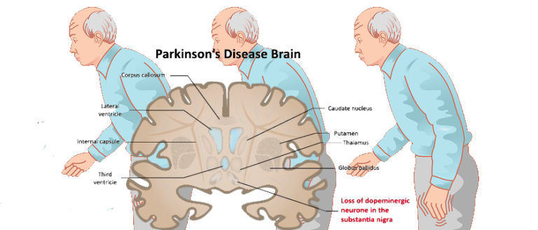 Parkinsons Disease Symptoms Causes Complications Remedies