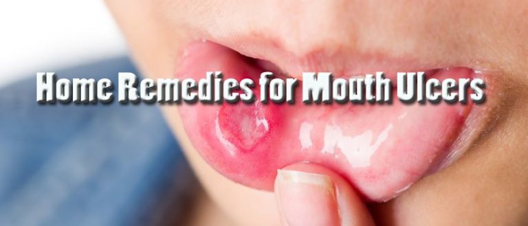 Best Home Remedies For Mouth Ulcers You Can Do 6055